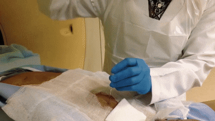 ULTRASOUND GUIDED BIOPSY ROCKY POINT SONORA MEXICO ONCOLOGIC IMAGING.gif