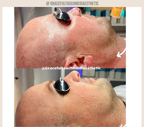 Reversed aging, fine lines & wrinkles