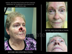 Nasal Cancer Reconstruction