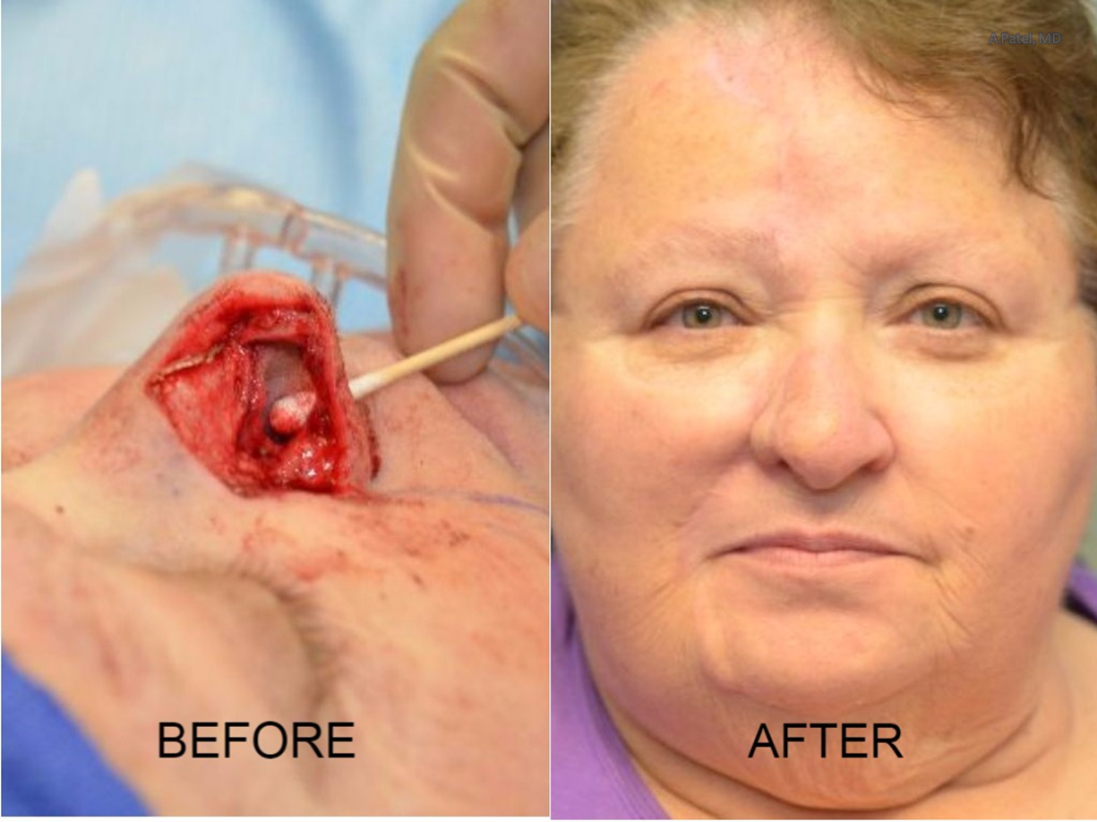 Nose Reconstruction