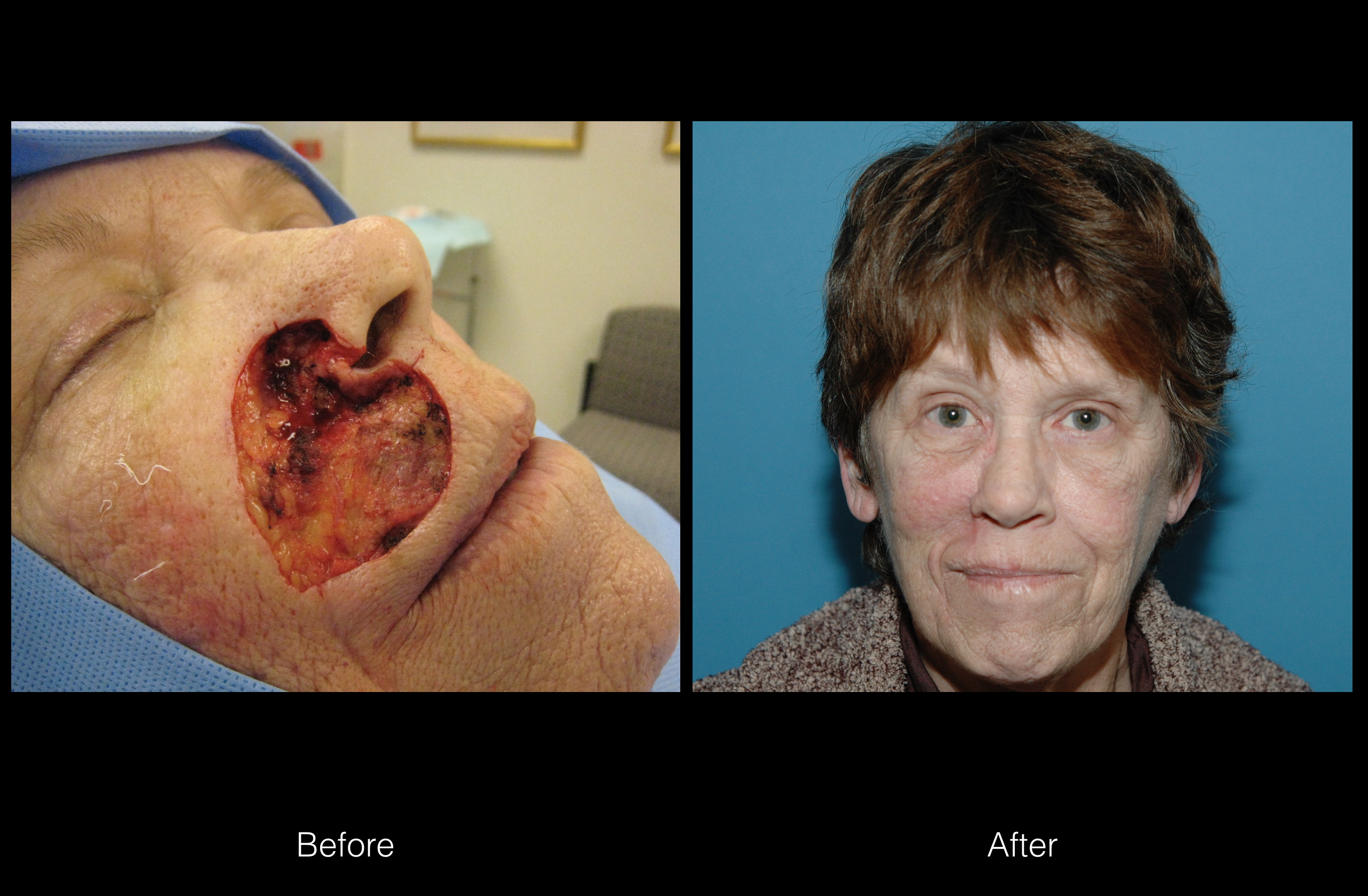 Lip Reconstruction