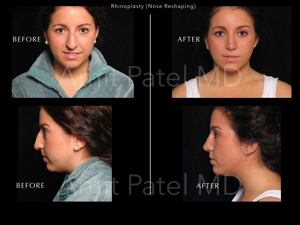 Rhinoplasty (Nose Job)
