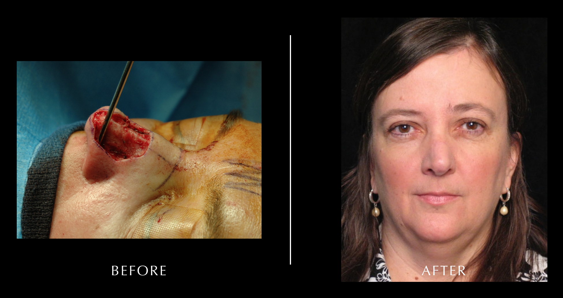 Cancer Reconstruction