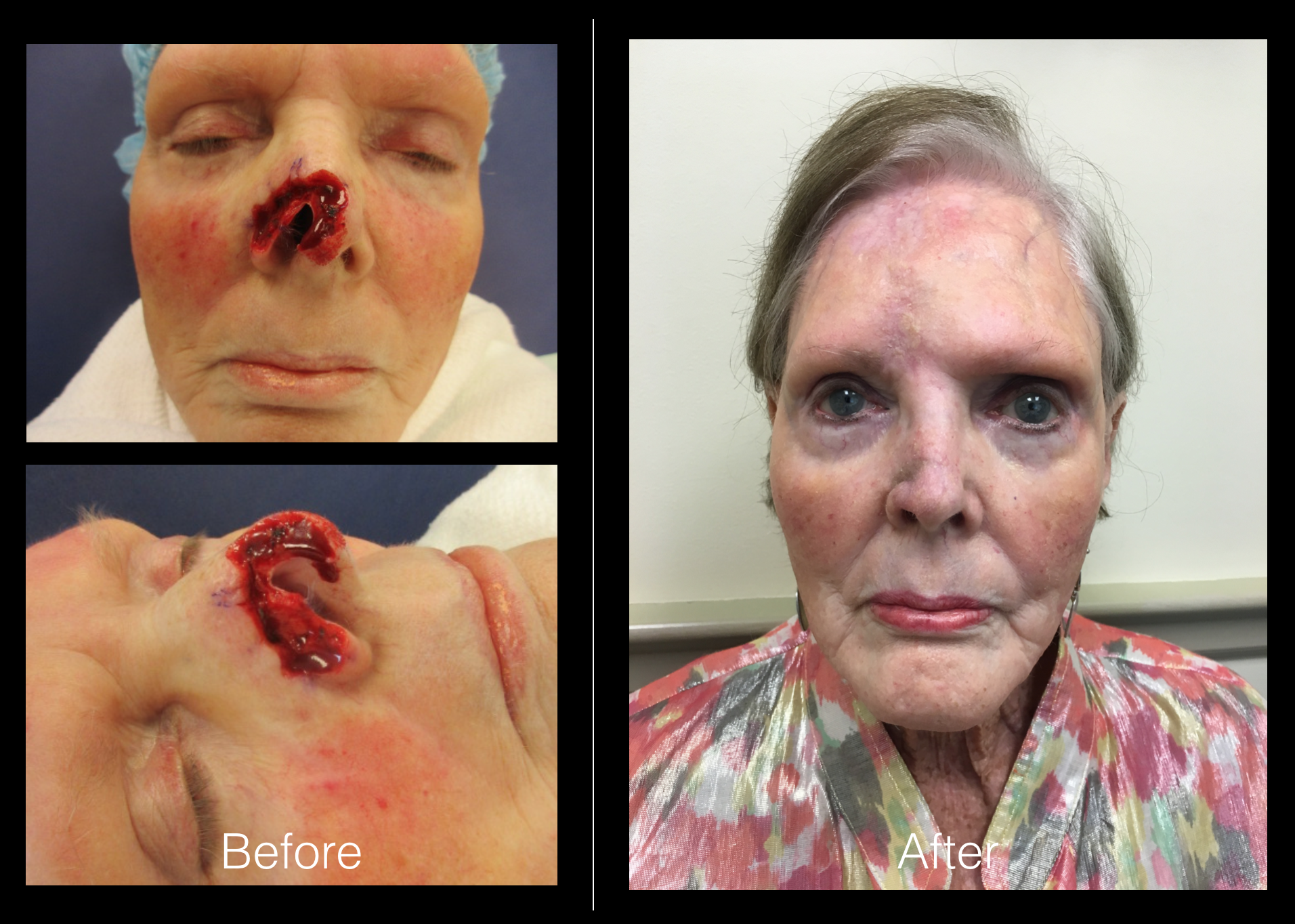 Cancer Reconstruction