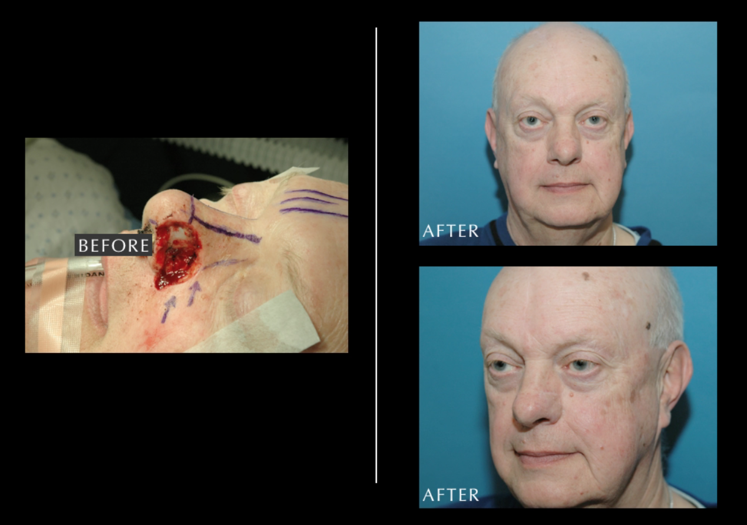 Cancer Reconstruction
