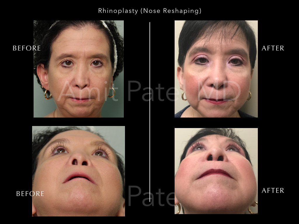 Revision Rhinoplasty - Nose Job
