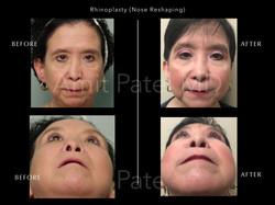 Revision Rhinoplasty - Nose Job