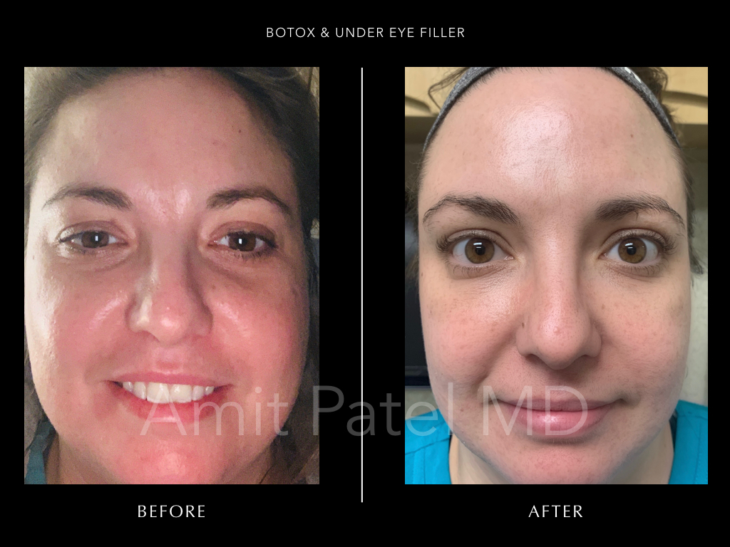 Botox & Under Eye Filler