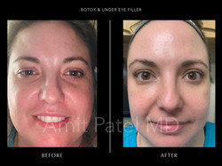 Botox & Under Eye Filler