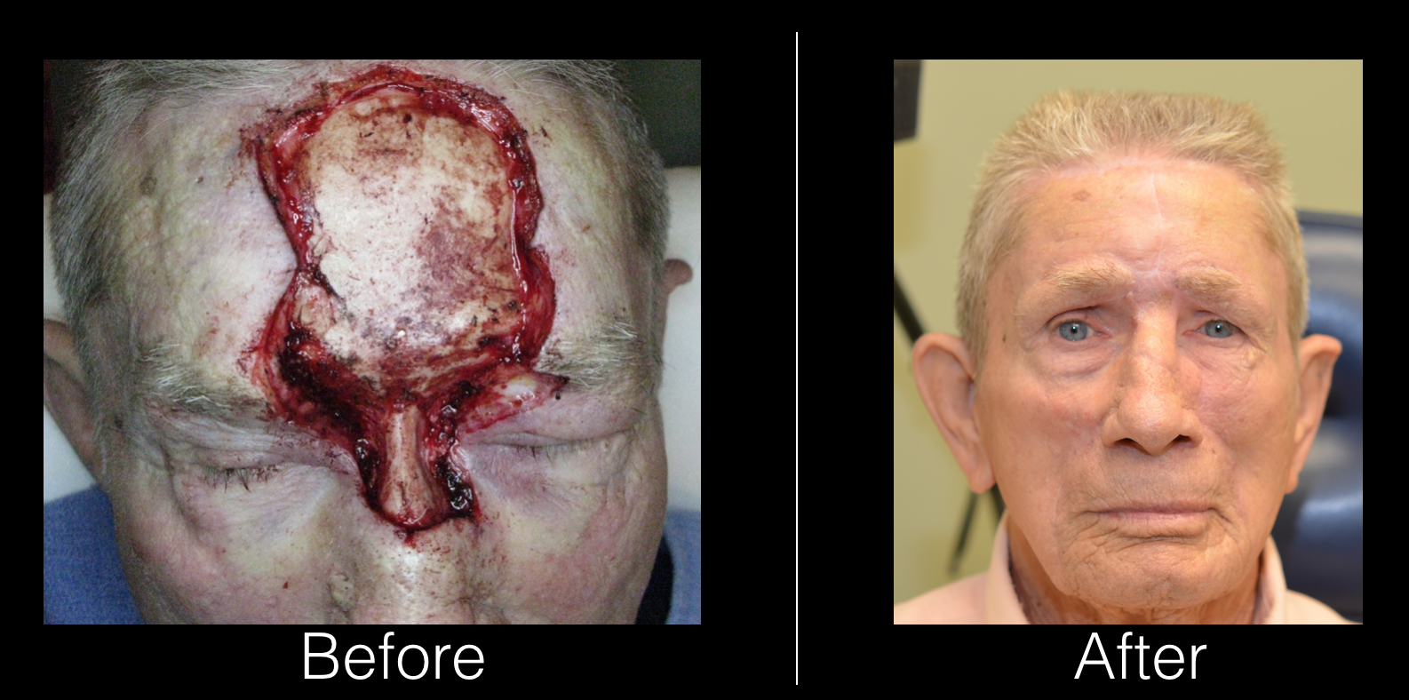 Forehead Reconstruction