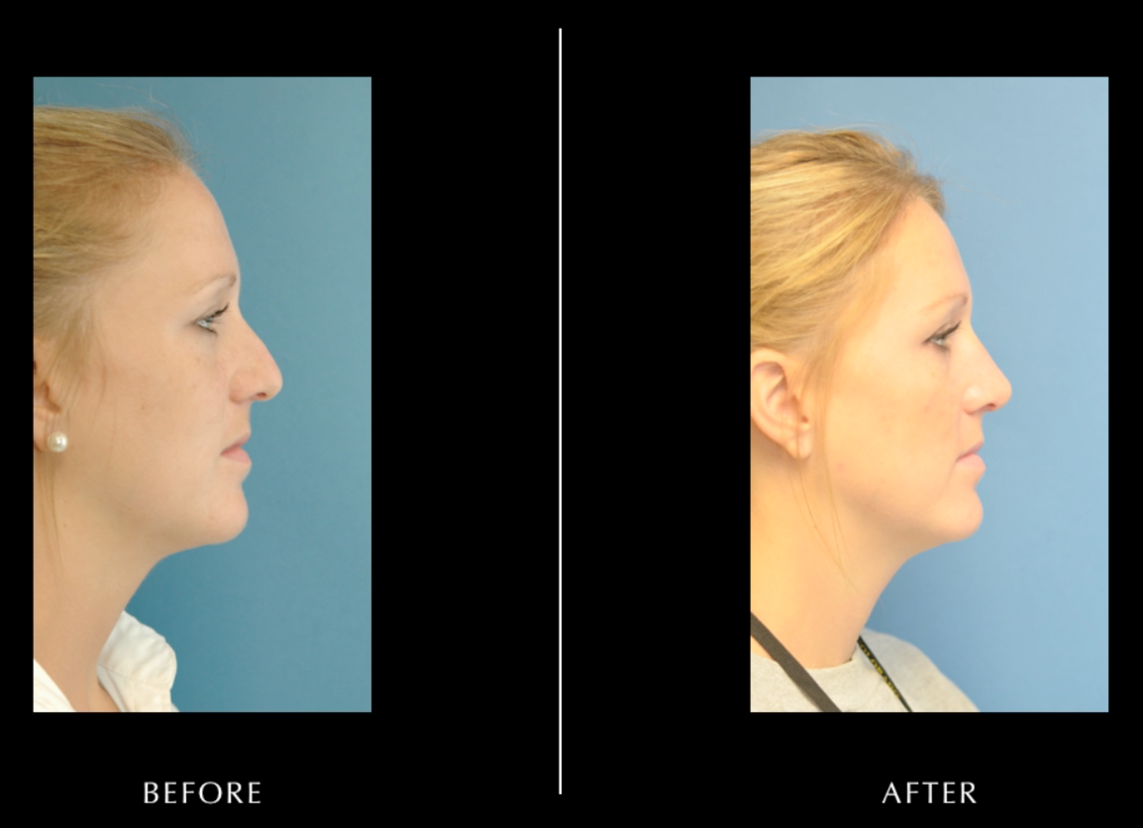 Rhinoplasty (Nose Job)