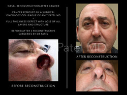 Nasal Cancer Reconstruction