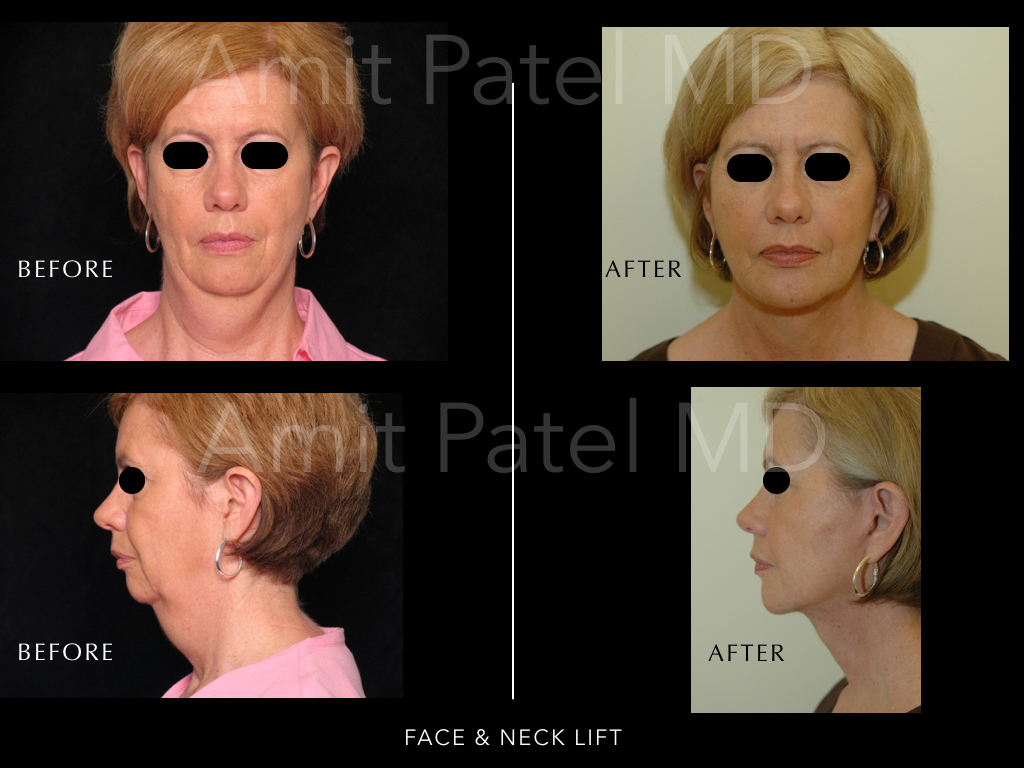 Facelift & Necklift