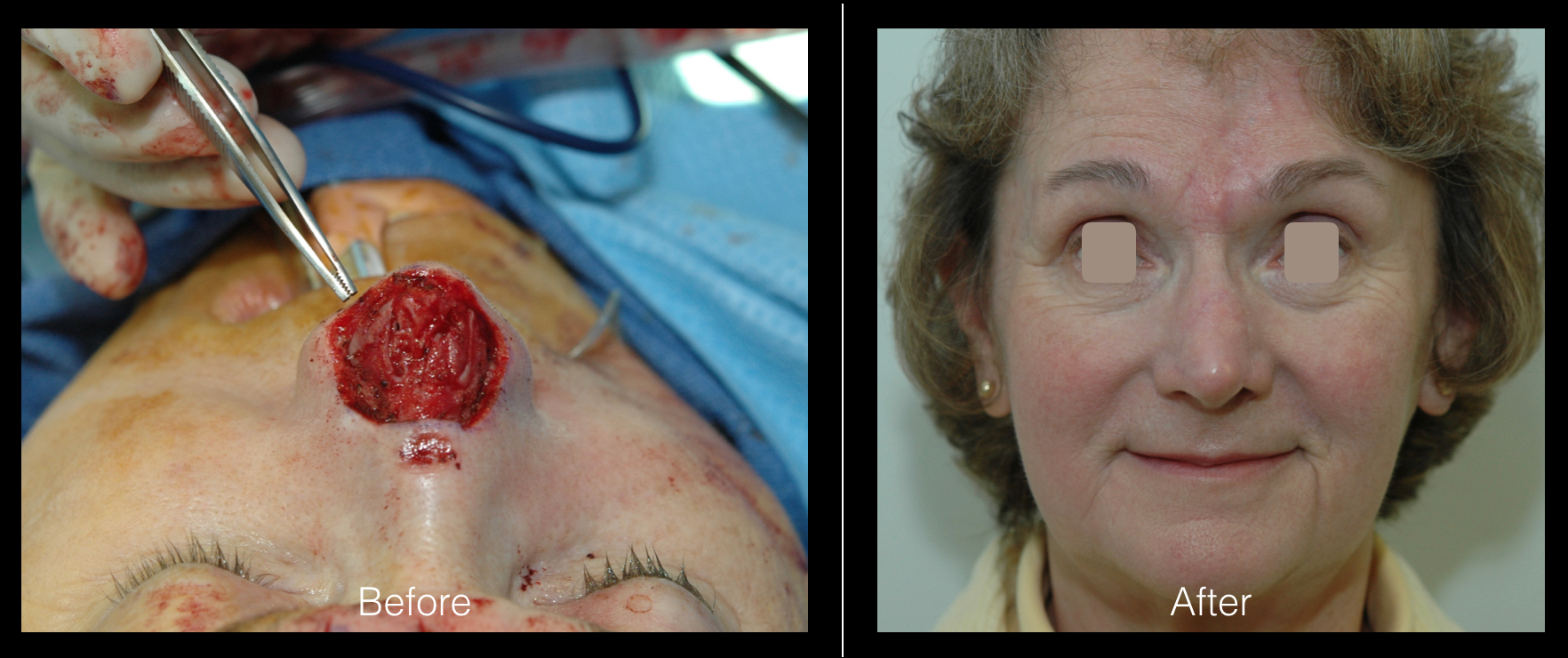 Cancer Reconstruction
