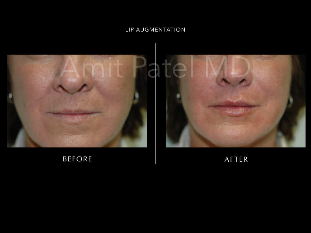 Lip Augmentation ~ Lip Filler