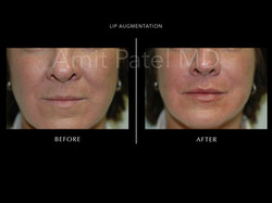 Lip Augmentation ~ Lip Filler