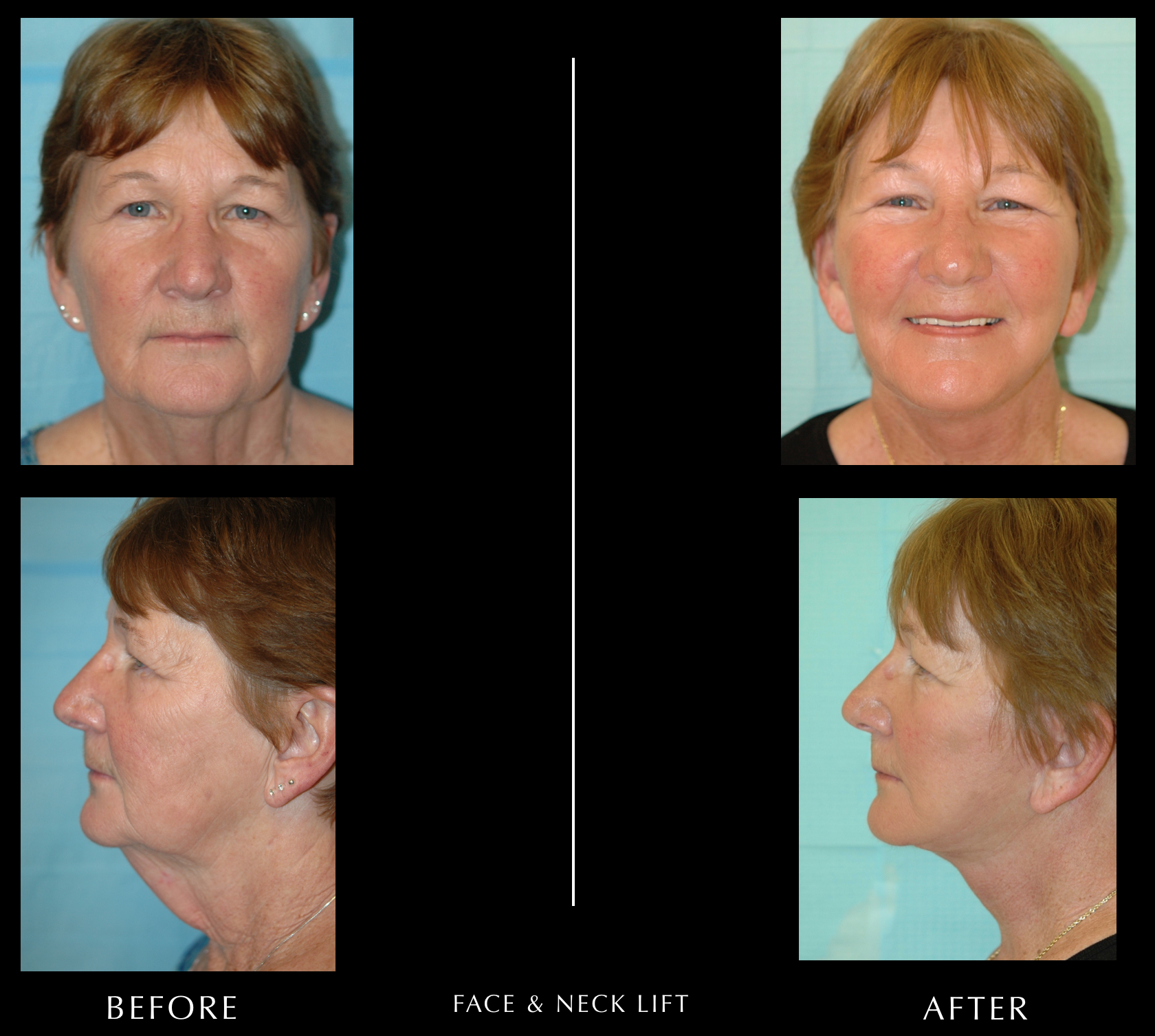 Facelift & Necklift