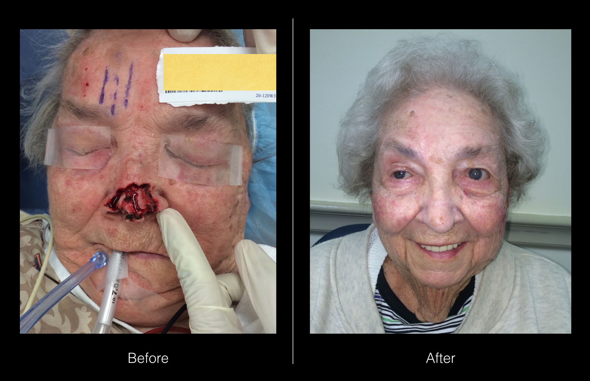 Nose Reconstruction