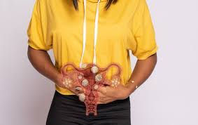 What are Fibroids? 