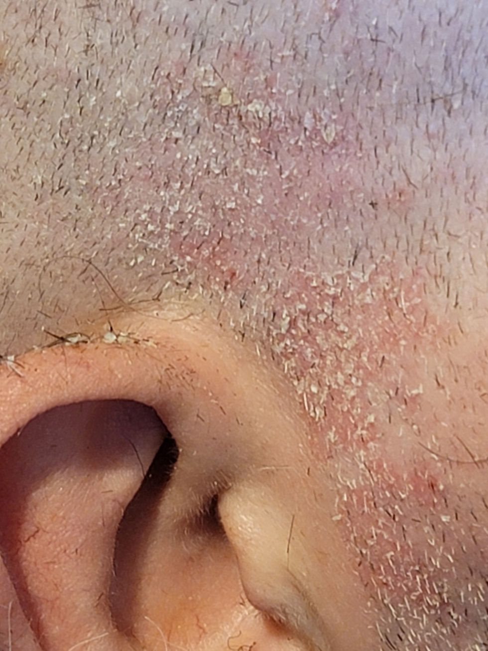 The rash around my ears