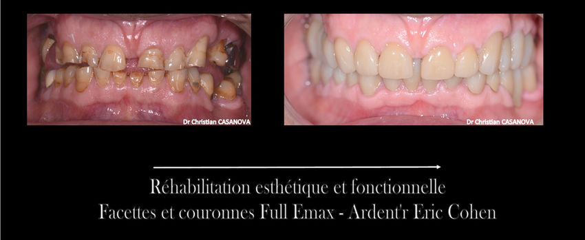 Frassanito - Facettes Couronnes.jpg