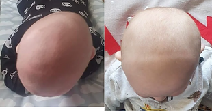 plagiocephaly comparison before and afterpng