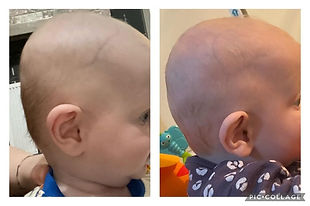 brachycephaly comparison before and after