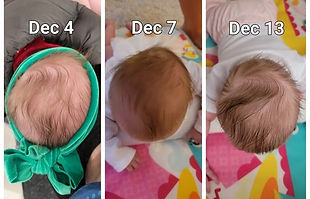 plagiocephaly comparison before and after