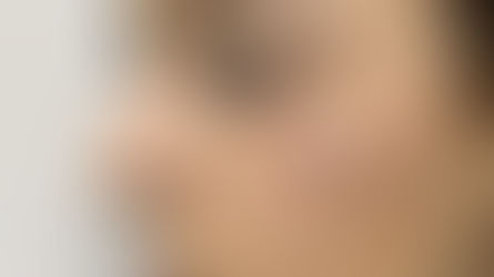 Colocação e Remoção de Micro Dermal no centro do Rio de Janeiro.