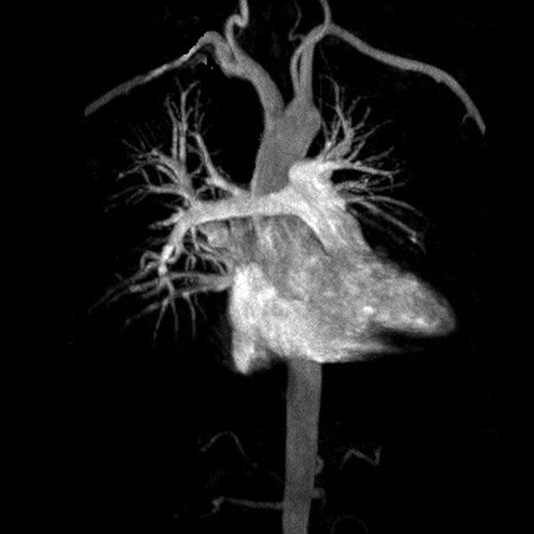 Cardiac MRI Angiogram
