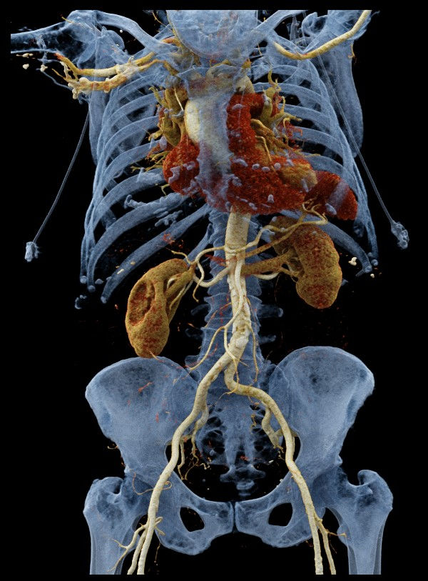 Volume Rendering Technique (VRT) of the thoracic and abdominal aorta for TAVI planning.