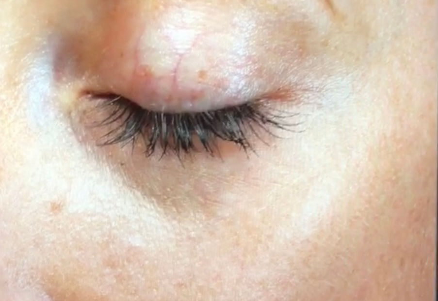 fine lines and wrinkles before using skinceuticals