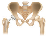 Ultrasound-guided hip steroid injection for hip arthritis pain