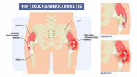 hip bursitis vs arthritis