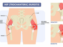 hip bursitis vs arthritis