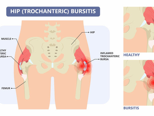 hip bursitis vs arthritis