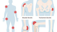 Medical illustration showing common types of bursitis including shoulder bursitis, trochanteric bursitis, knee bursitis, elbow bursitis, and heel bursitis.