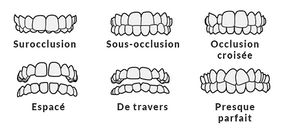 Aligneurs-dentaire-2 _ Cabinet-Patricia-Assayag-Strauss-Colmar.JPG