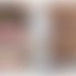 Dentes fixos em menos de uma semana com a técnica "All on four"