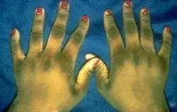 acanthosis_nigricans_landing.jpg