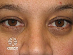 Xanthelasma