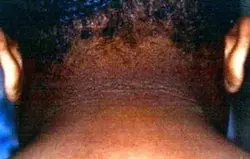 acanthosis_nigricans_symptoms_neck-.jpg