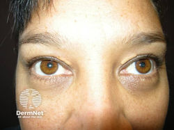 Xanthelasma