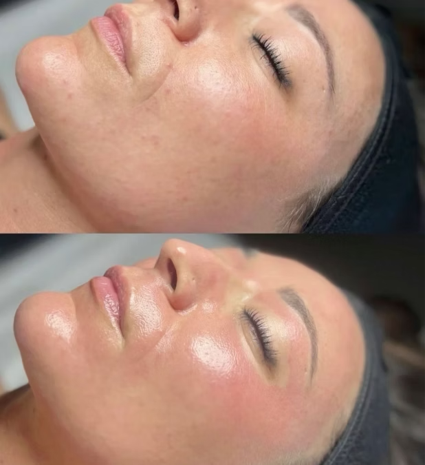 Före efter exosomer LAX DNA