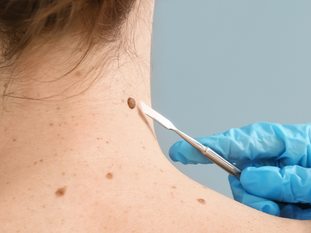 Debunking Common Myths About Skin Cancer: Facts and Statements You Should Know 🤔