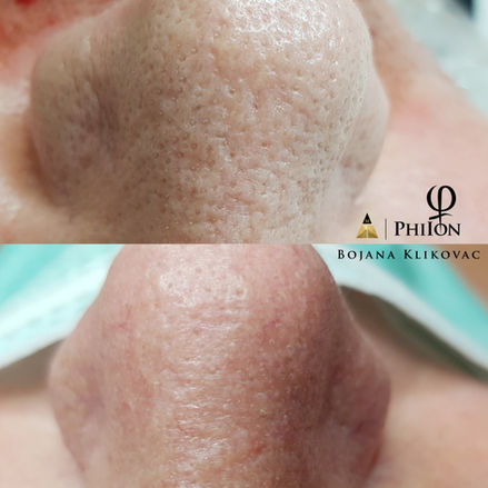 Hårdnad talg borttagning med Plasma Pen hos HudExpert, Plasma Pen och Microneedling Master Bojana Klikovac på Beauty Phix Center i Stockholm.