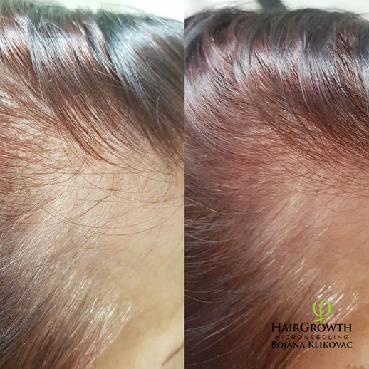 Har du upptäckt tecken på håravfall eller tunnhårighet? Med denna kombinationsbehandling av microneedling och speciellt hårstimulerande Hair Growth serum kan du nu återfå hårväxten, samt motverka framtida håravfall.
Här gäller det att boka in er snarast för att hinna stimulera hårbotten i tid!
Före behandlingen är det nödvändigt att göra en Digital Skalp och Håranalys för att exakt kunna avgöra vilket sorts håravfall det rör sig om.