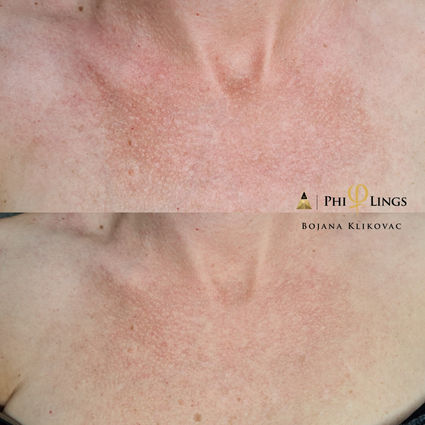 Behandling av pigmentfläckar med Microneedling PhiBright teknik hos Certifierad HudExpert Bojana Klikovac på Beauty Phix Center i Stockholm.