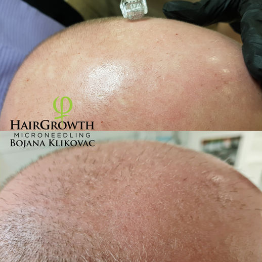 Har du upptäckt tecken på håravfall eller tunnhårighet? Hos Certifierad Hair Growth terapeut Bojana Klikovac kan du nu återfå hårväxten, samt motverka framtida håravfall. Här gäller det att boka in behandling snarast för att hinna stimulera hårbotten i tid! Före behandlingen är det nödvändigt att göra en Digital Skalp och Håranalys för att exakt kunna avgöra vilket sorts håravfall det rör sig om. Välkommen på Beauty Phix Center i Stockholm!