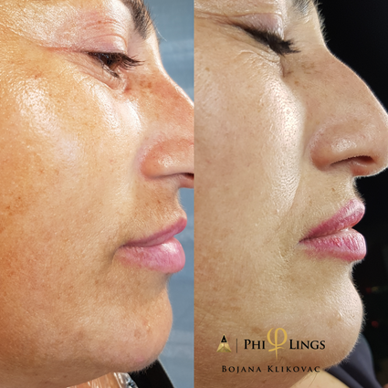 Behandling av pigmentfläckar med Microneedling PhiBright teknik hos Certifierad HudExpert Bojana Klikovac på Beauty Phix Center i Stockholm.